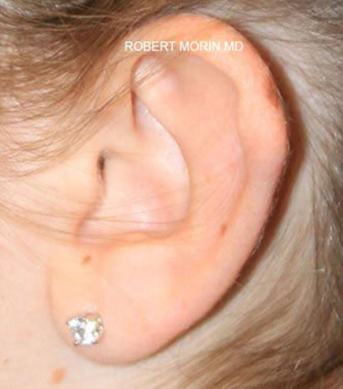 Otoplasty Hackensack Cosmetic Ear Surgery Nj