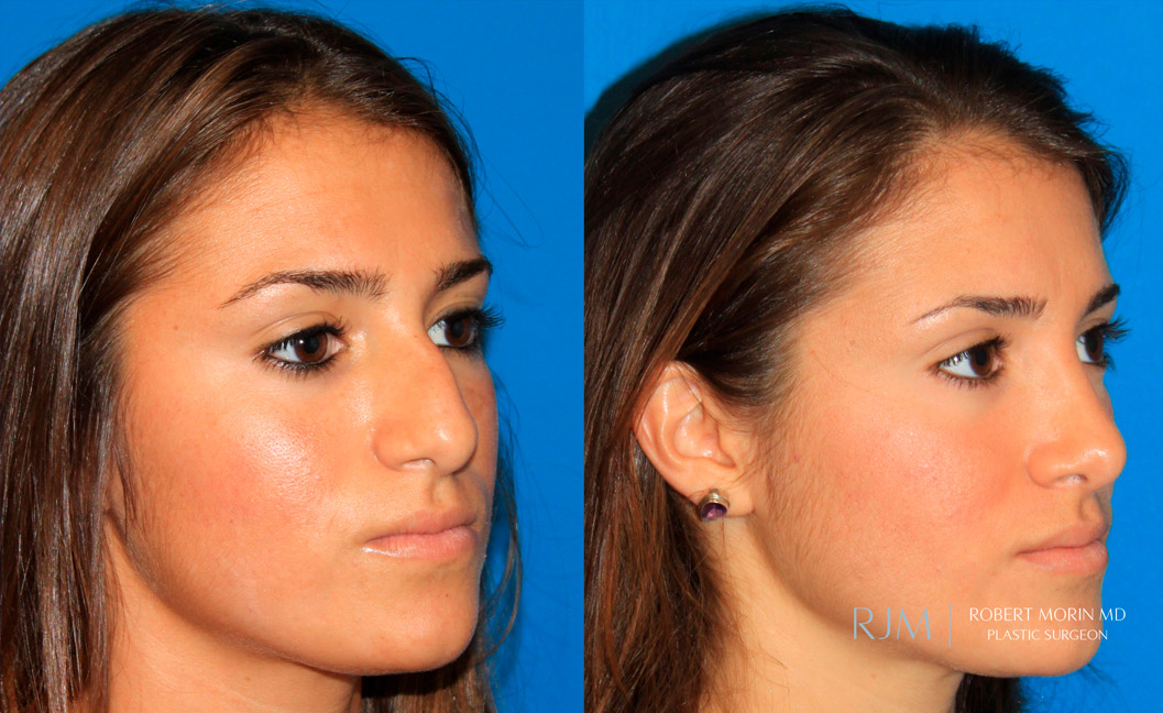 Woman's face, before and after Rhinoplasty treatment, oblique view, patient 1