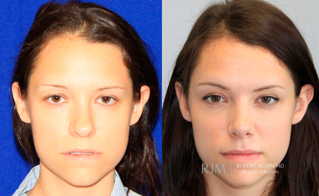 Woman's face, before and after Rhinoplasty treatment, front view, patient 2