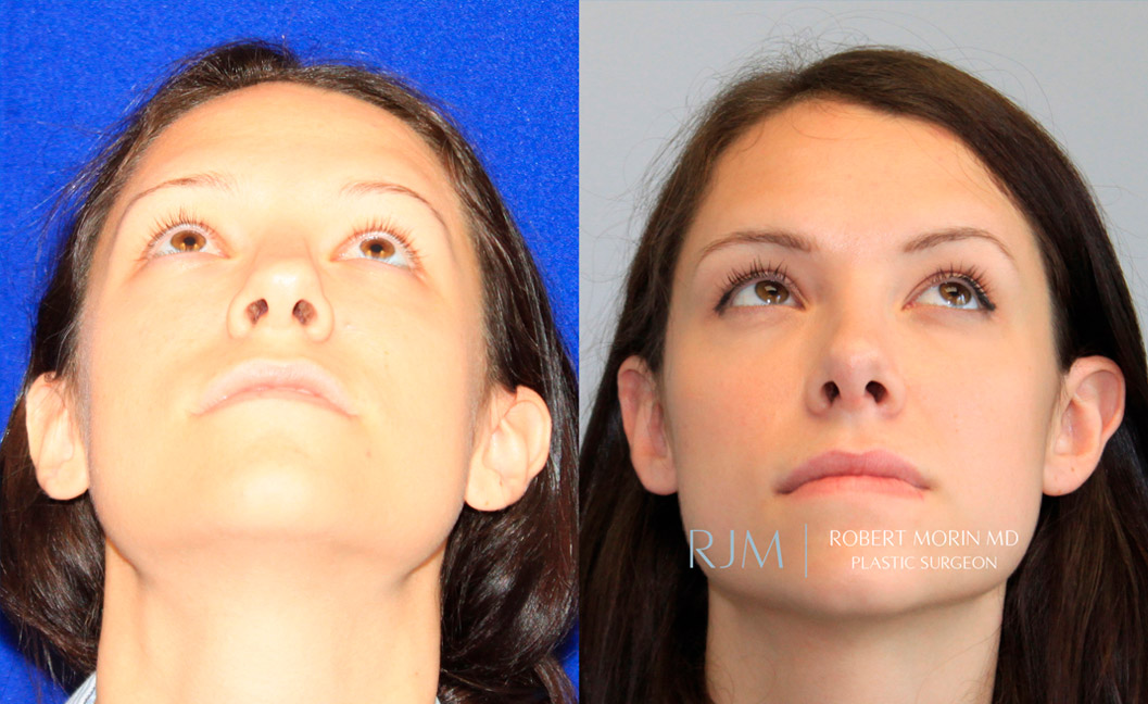 Woman's face, before and after Rhinoplasty treatment, thrown back view, patient 2