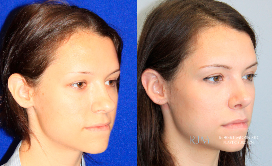 Woman's face, before and after Rhinoplasty treatment, oblique view, patient 2
