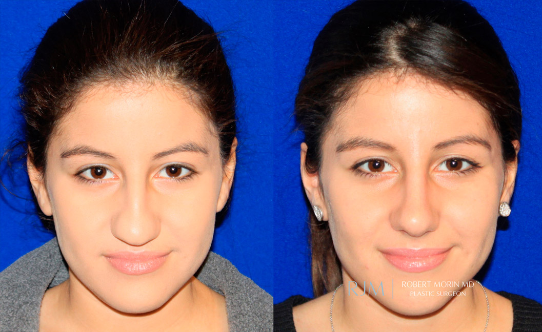 Woman's face, before and after Rhinoplasty treatment, front view, patient 3