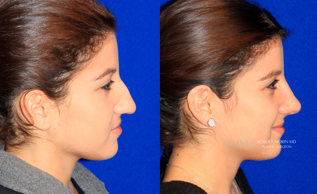 Woman's face, before and after Rhinoplasty treatment, side view, patient 3