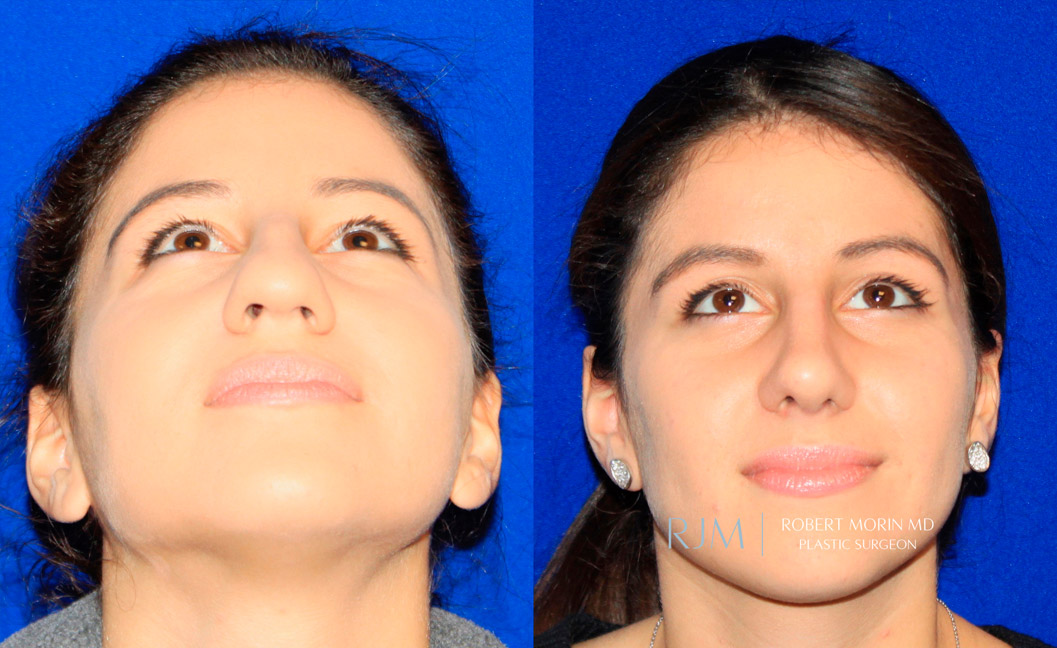 Woman's face, before and after Rhinoplasty treatment, thrown back view, patient 3