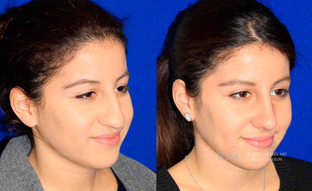 Woman's face, before and after Rhinoplasty treatment, oblique view, patient 3