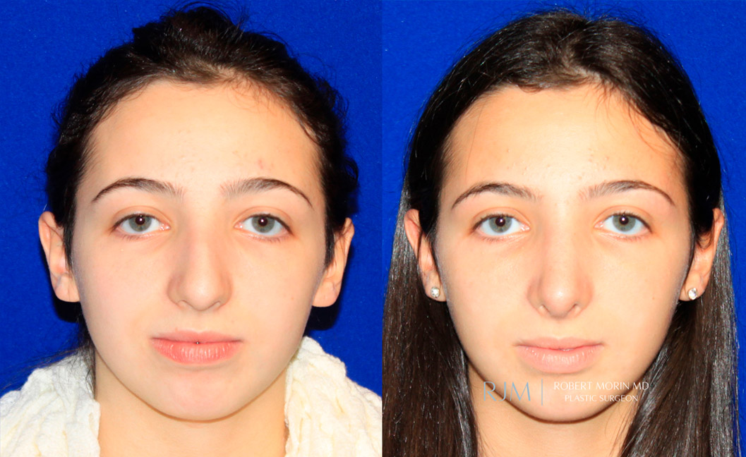 Young girl face, before and after Rhinoplasty treatment, front view, patient 4