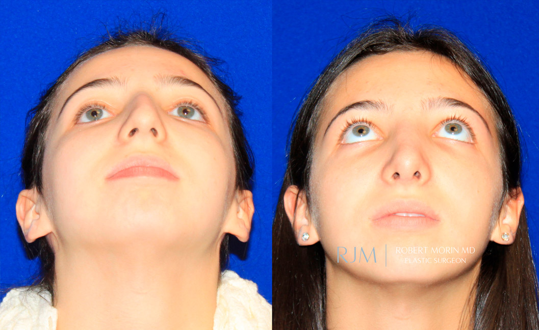 Young girl face, before and after Rhinoplasty treatment, thrown back view, patient 4