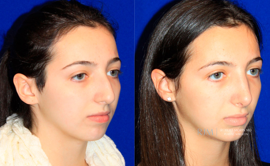 Young girl face, before and after Rhinoplasty treatment, oblique view, patient 4