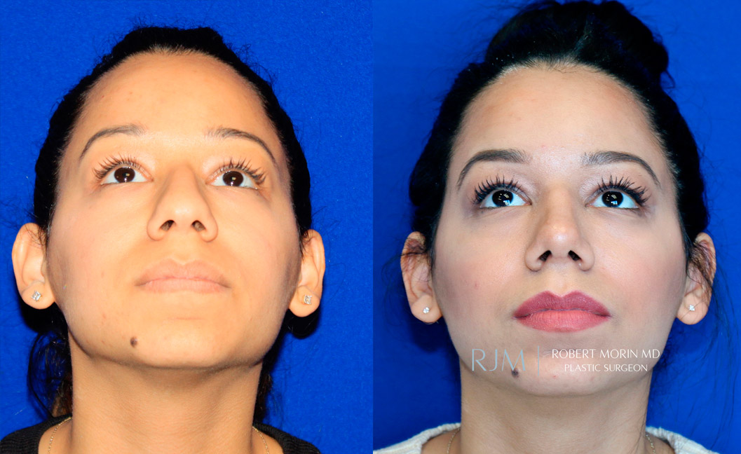 Female face, before and after Rhinoplasty treatment, thrown back view, patient 5