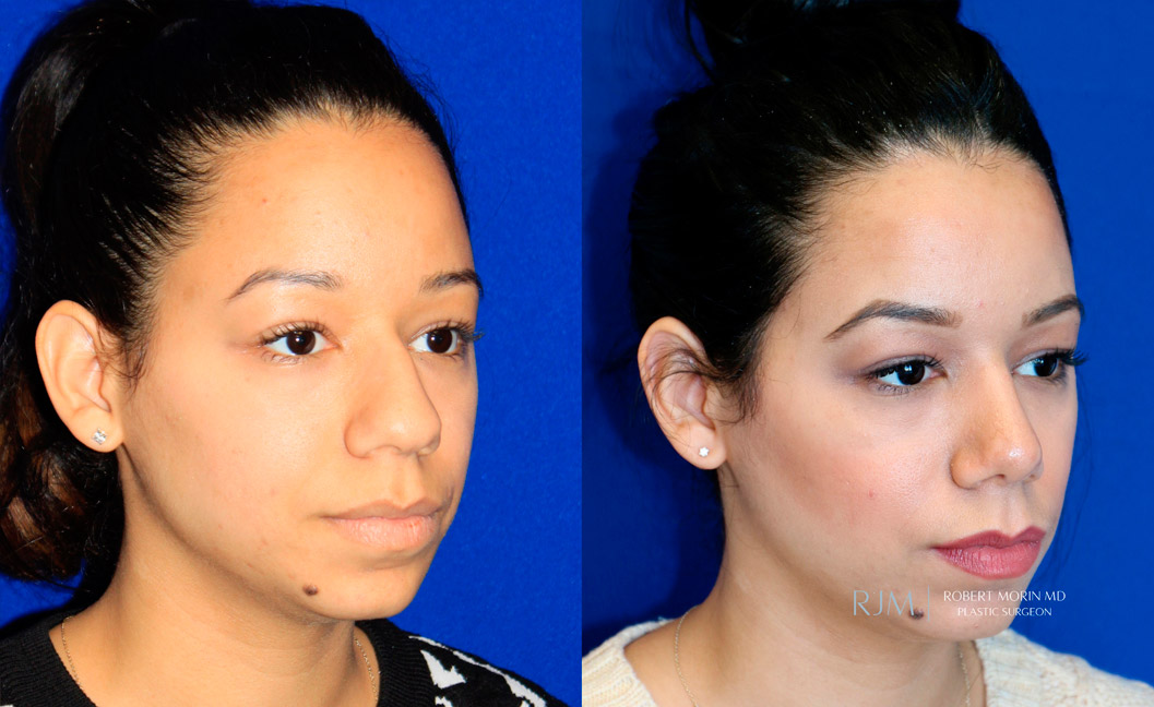Female face, before and after Rhinoplasty treatment, oblique view, patient 5