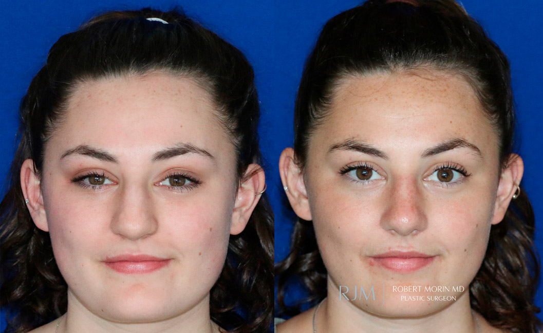 Female face, before and after Rhinoplasty treatment, front view, patient 6