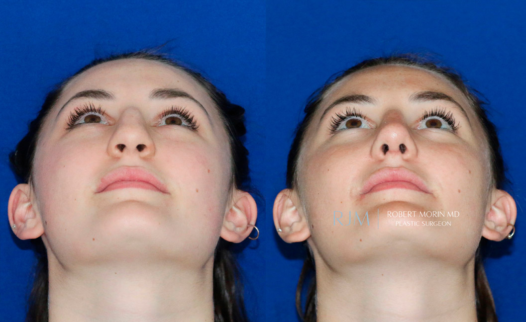 Female face, before and after Rhinoplasty treatment, thrown back view, patient 6