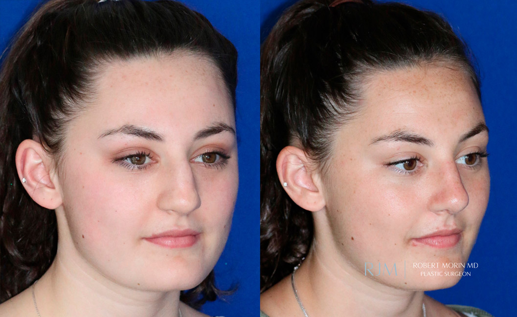 Female face, before and after Rhinoplasty treatment, oblique view, patient 6
