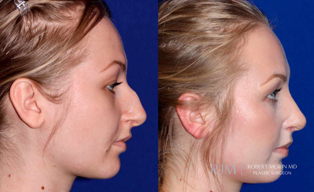 Woman's face, before and after Rhinoplasty treatment, side view, patient 7