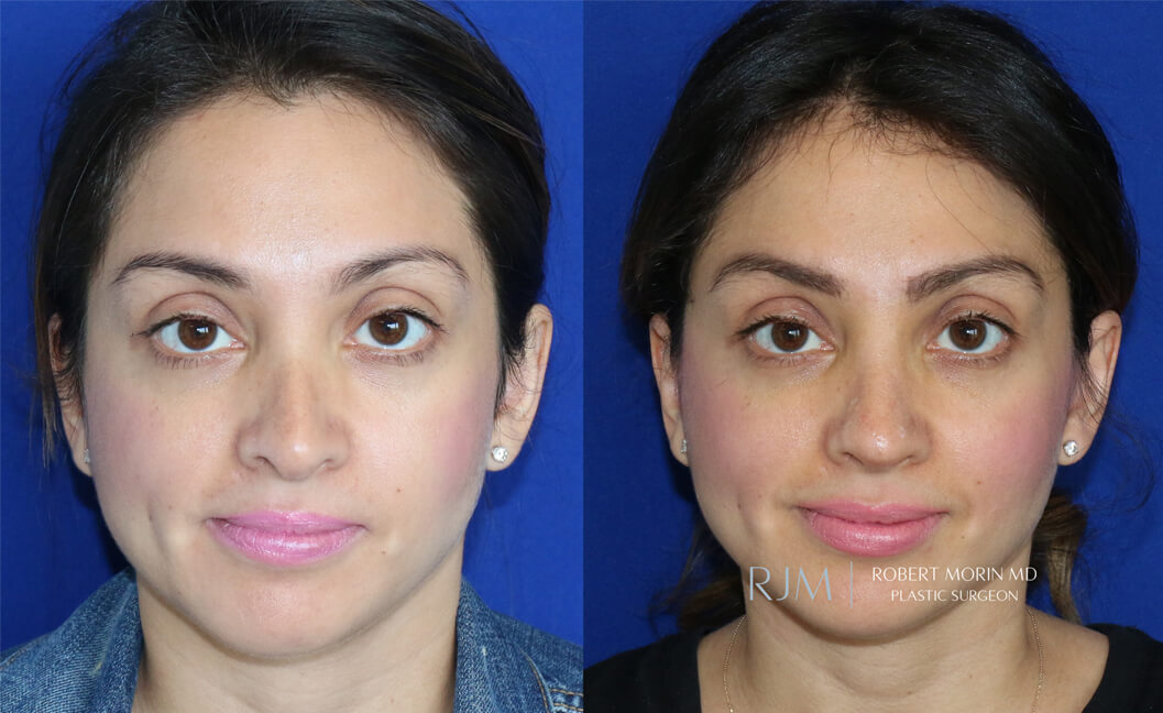 Patient face, before and after Revision Rhinoplasty treatment, set 1 - patient 1