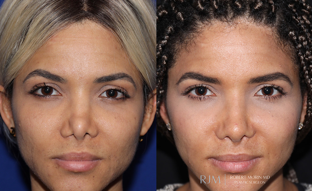 Patient face, before and after Revision Rhinoplasty treatment, set 1 - patient 2