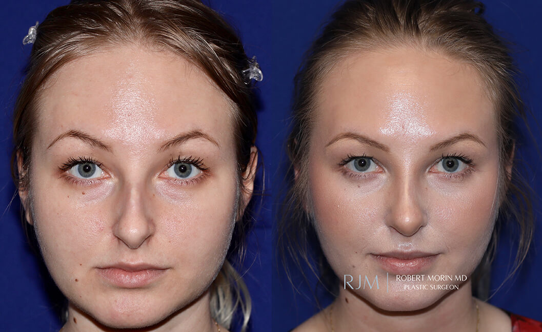Woman's face, before and after Rhinoplasty treatment, oblique view, patient 7