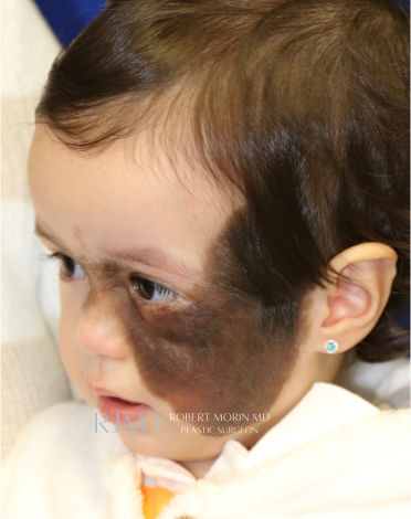 congenital nevus removal before and after