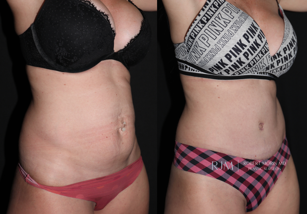 Tummy Tuck Before & After Gallery: Patient 27