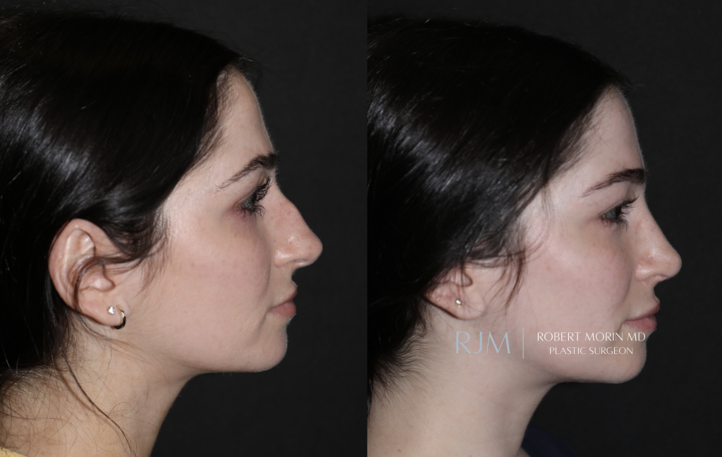  Before and after rhinoplasty patient Robert Morin MD
