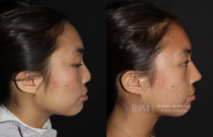  Cleft lip rhinoplasty before and after Robert Morin MD