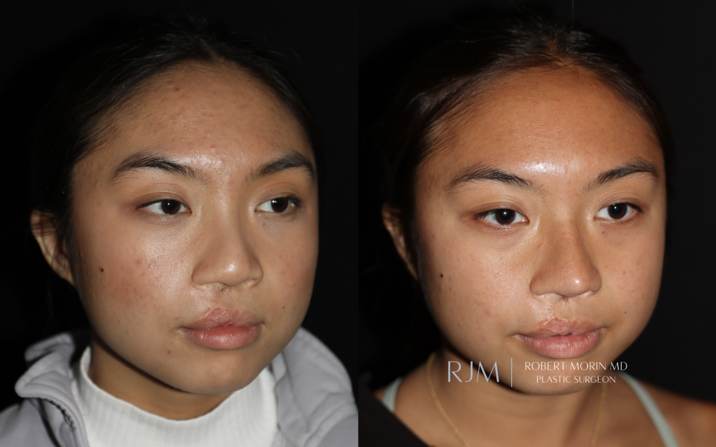  Cleft lip rhinoplasty before and after Robert Morin MD