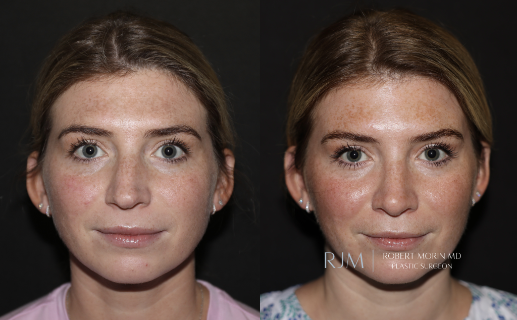  Before and after rhinoplasty Robert Morin MD