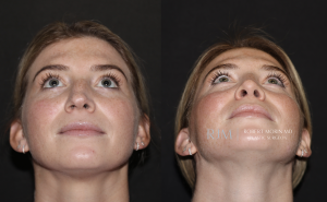  Before and after rhinoplasty Robert Morin MD