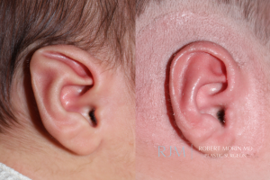  Infant ear molding Stahl ear deformity