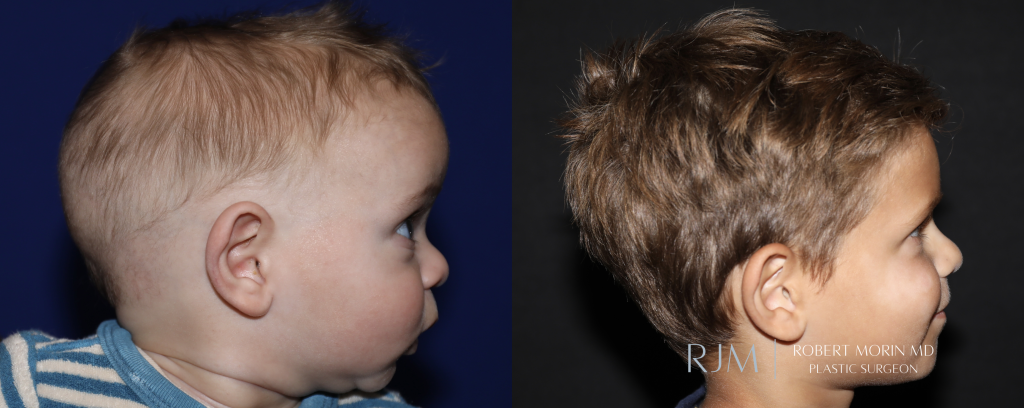  Sagittal craniosynostosis Robert Morin MD before and after