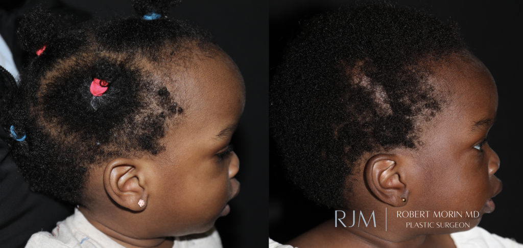  Sagittal craniosynostosis Robert Morin MD before and after