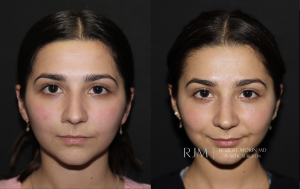  Before and after rhinoplasty Robert Morin MD