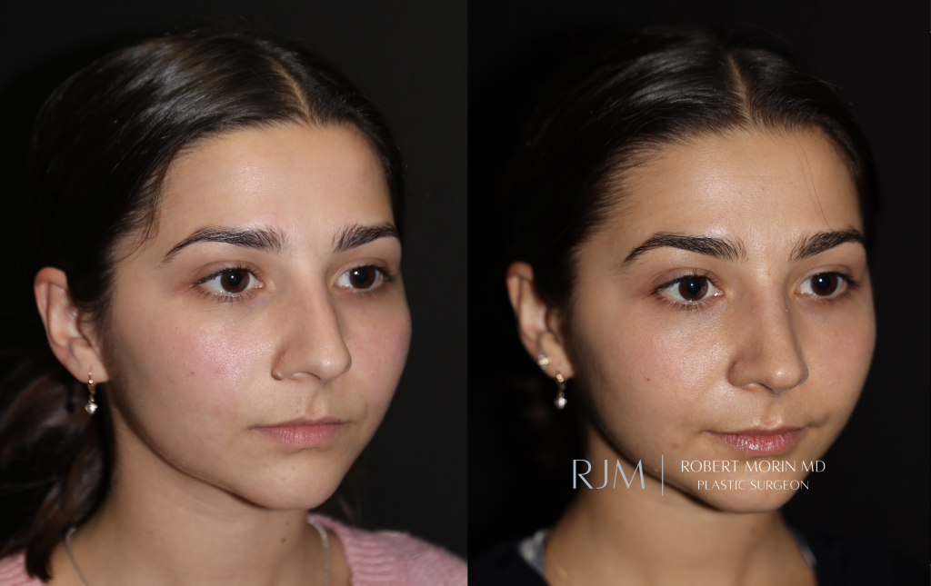  Before and after rhinoplasty Robert Morin MD