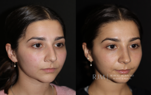  Before and after rhinoplasty Robert Morin MD