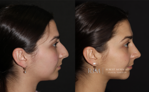  Before and after rhinoplasty Robert Morin MD