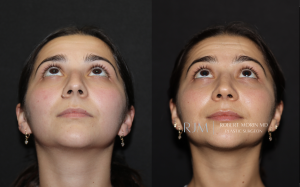  Before and after rhinoplasty Robert Morin MD