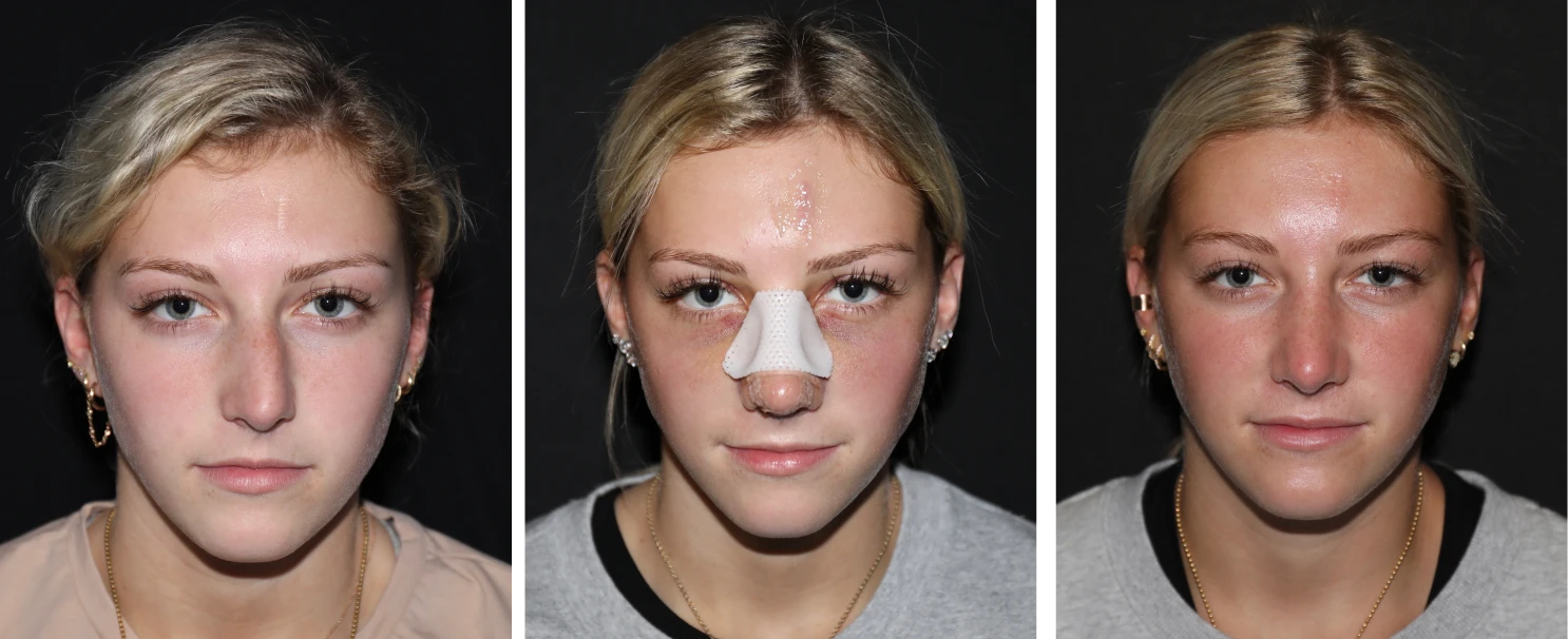 case studies before and after Rhinoplasty and Septoplasty