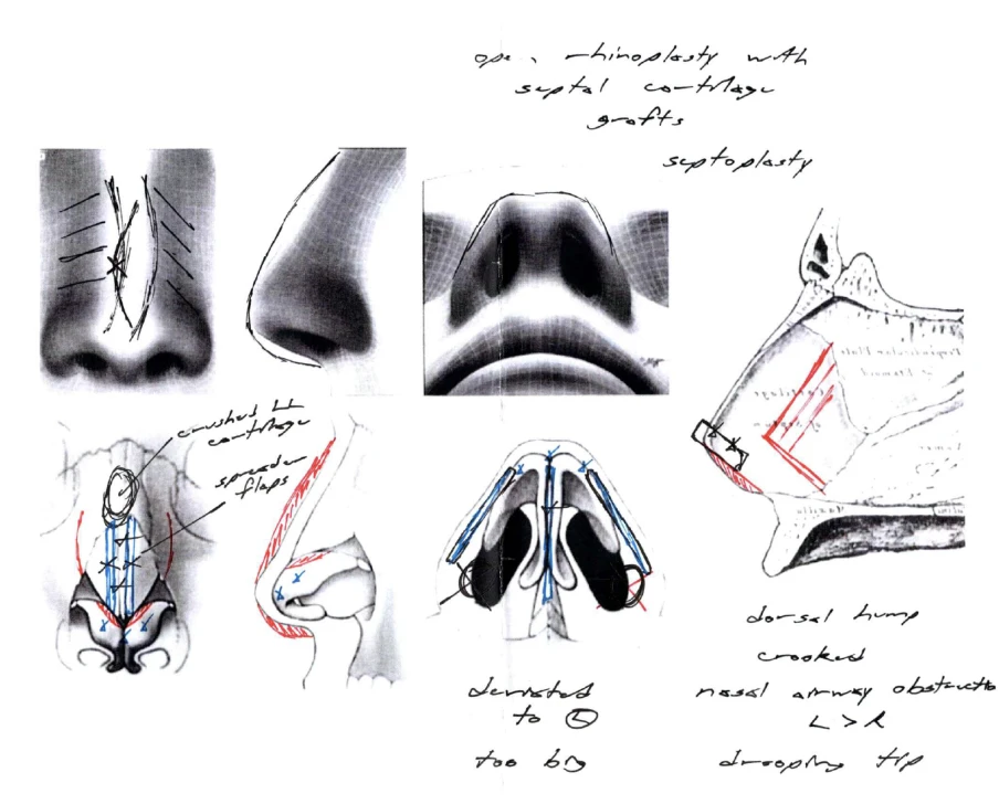 Description of Surgery Rhinoplasty and Septoplasty