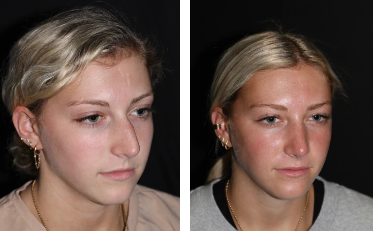 case studies Before & After Photos Rhinoplasty and Septoplasty 3