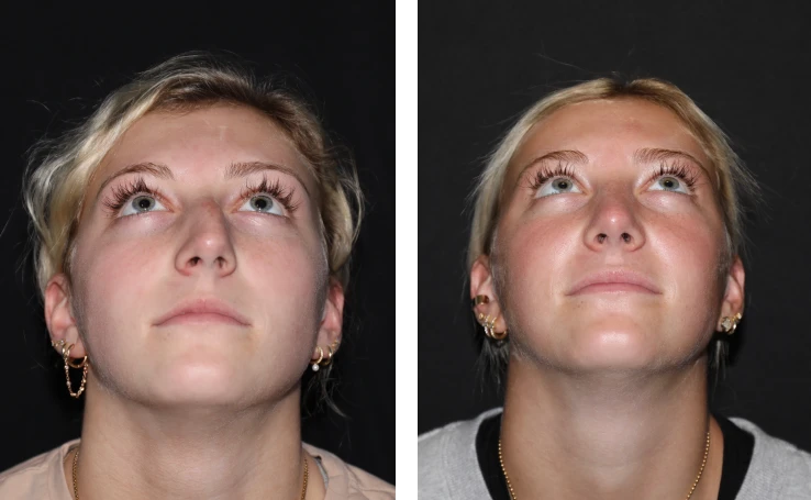 case studies Before & After Photos Rhinoplasty and Septoplasty 4