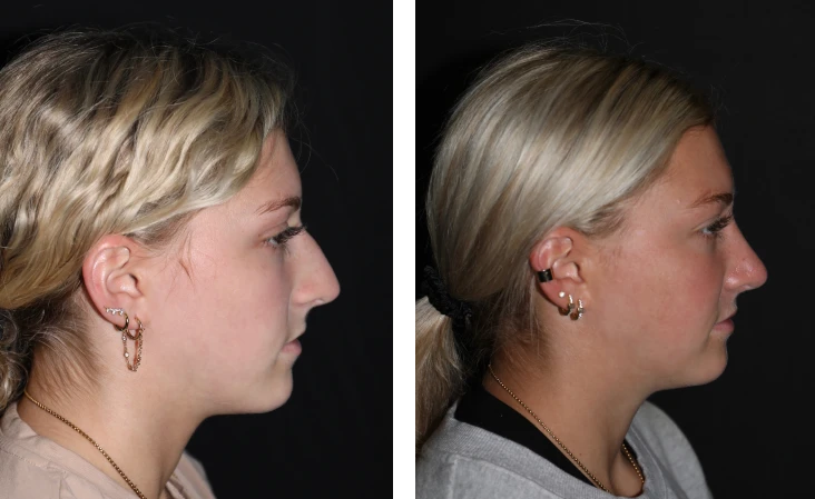 case studies Before & After Photos Rhinoplasty and Septoplasty 5