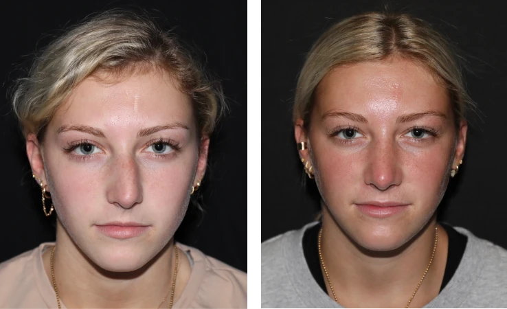 case studies Before & After Photos Rhinoplasty and Septoplasty 6