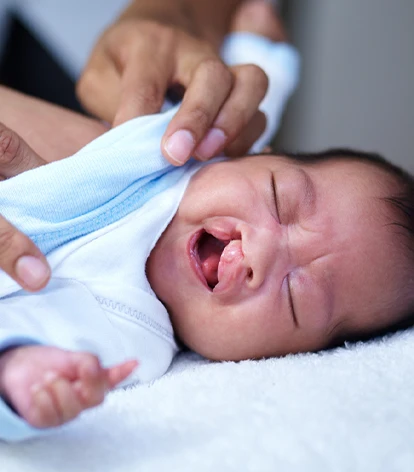 Baby With Cleft Lip and Palate