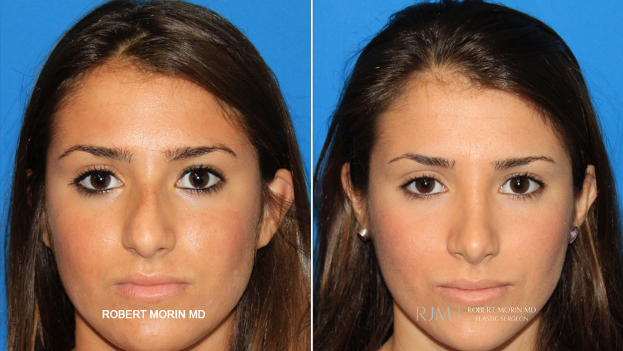 Contour Clinics - A refined nose bridge and elevated tip